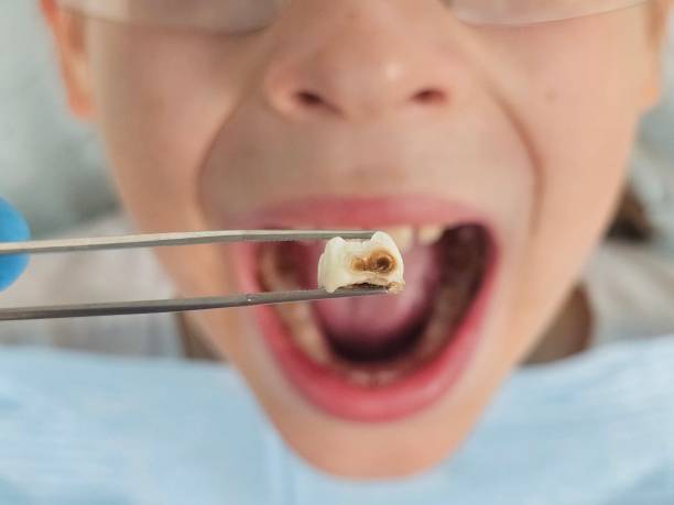 Best Broken or Cracked Tooth Emergency Dentist in Tonawanda, NY